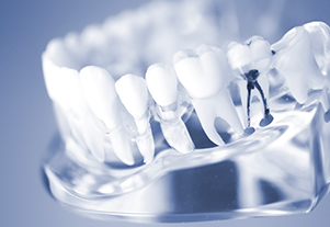 新柴又駅・木暮歯科クリニック・根管治療