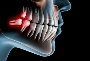 新柴又駅・木暮歯科クリニック・親知らず