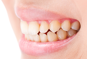 新柴又駅・木暮歯科クリニック・歯ぎしり・食いしばり